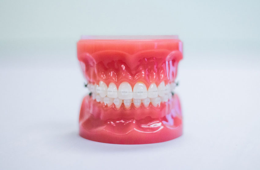 Ceramic-Braces-1